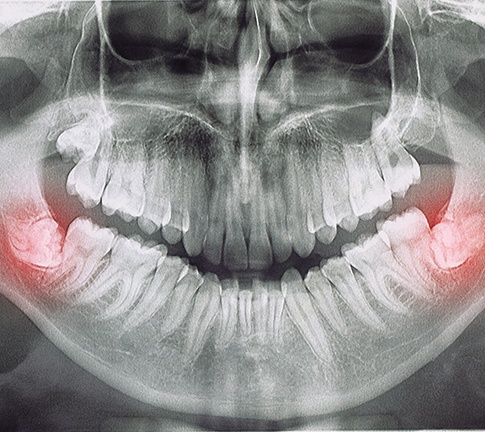 Wisdom teeth highlighted in red on dental X-ray