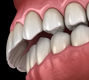 Illustration of overbite