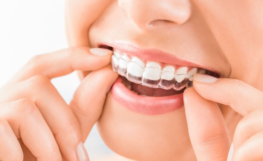 A woman putting on an Invisalign aligner.